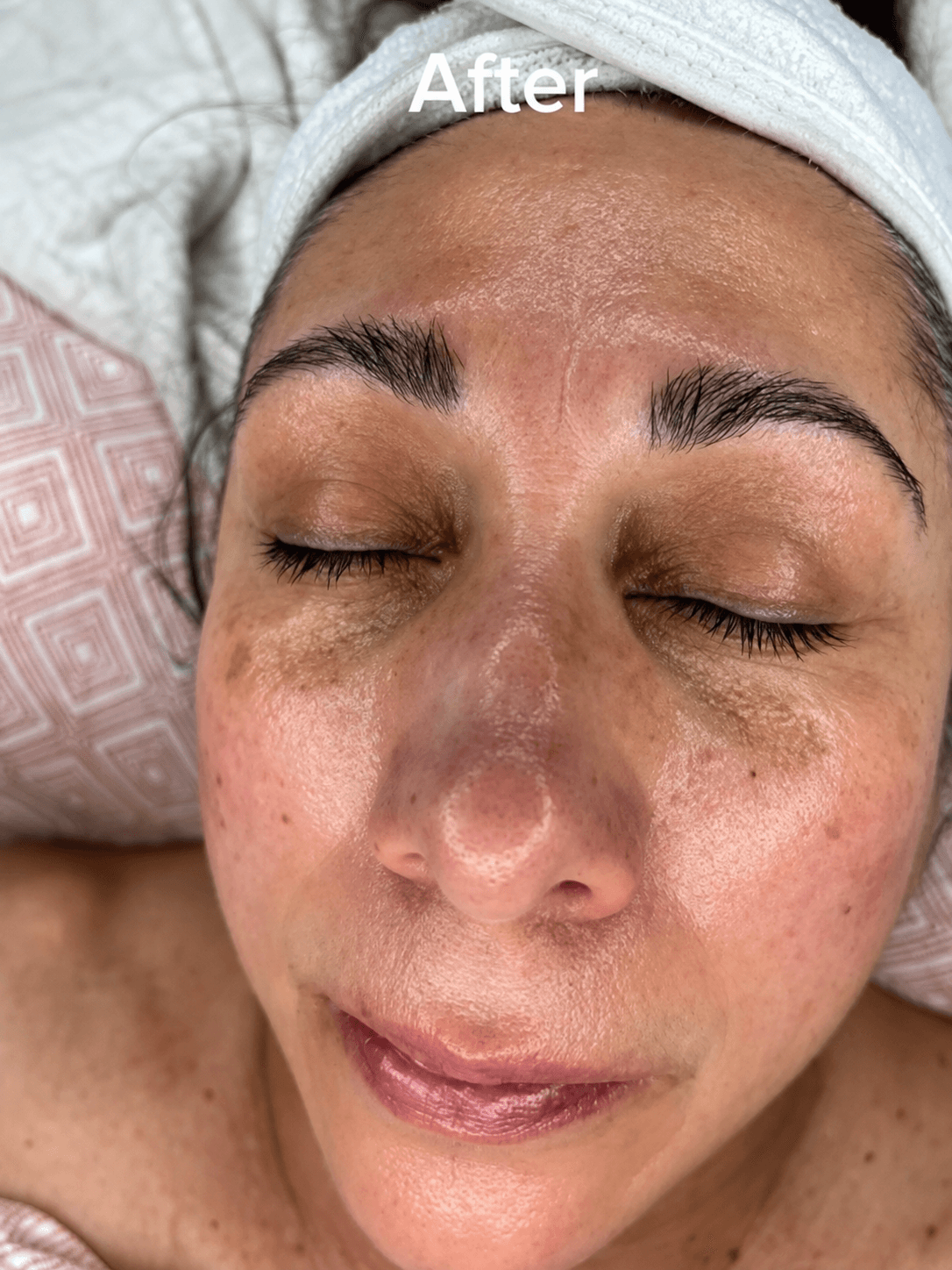 Skin after exfoliation treatment at Layers Skin Care by Gia