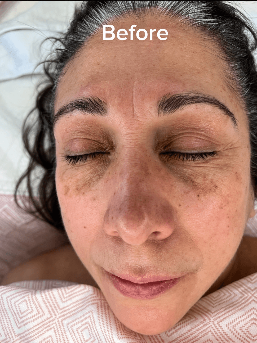 Skin before exfoliation treatment at Layers Skin Care by Gia